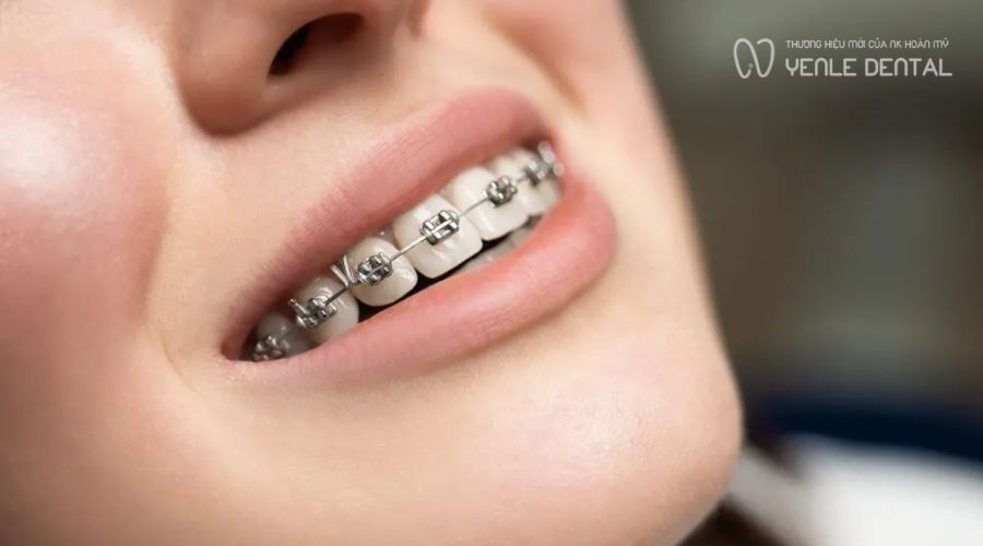 Niềng răng ở tuổi 40 có lâu không